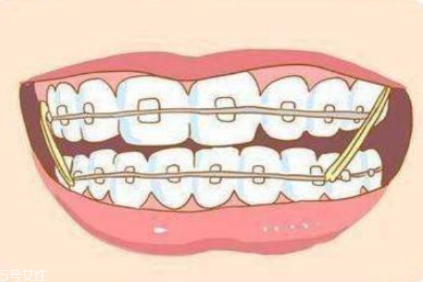 什么是支抗钉 打支抗钉有没有风险 