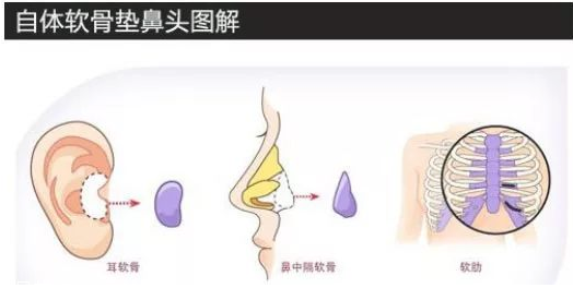 鼻子整形有几种方法 鼻子整形哪种方法比较好 