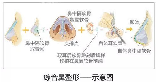 鼻子整形有几种方法 鼻子整形哪种方法比较好 