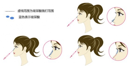 鼻子整形有几种方法 鼻子整形哪种方法比较好 